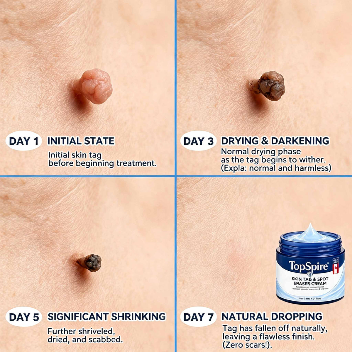 TopSpire® 7-𝐃𝐚𝐲 𝐒𝐤𝐢𝐧 𝐓𝐚𝐠 & 𝐒𝐩𝐨𝐭 𝐄𝐫𝐚𝐬𝐞𝐫 𝐂𝐫𝐞𝐚𝐦 (Zero Pain, Zero 𝐒𝐜𝐚𝐫𝐬 Formula)🌱