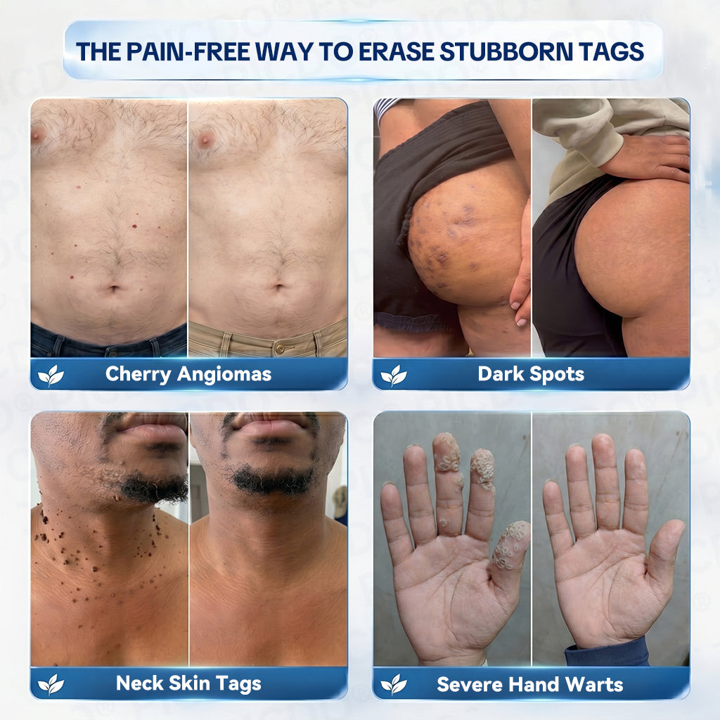 TopSpire® 7-𝐃𝐚𝐲 𝐒𝐤𝐢𝐧 𝐓𝐚𝐠 & 𝐒𝐩𝐨𝐭 𝐄𝐫𝐚𝐬𝐞𝐫 𝐂𝐫𝐞𝐚𝐦 (Zero Pain, Zero 𝐒𝐜𝐚𝐫𝐬 Formula)🌱