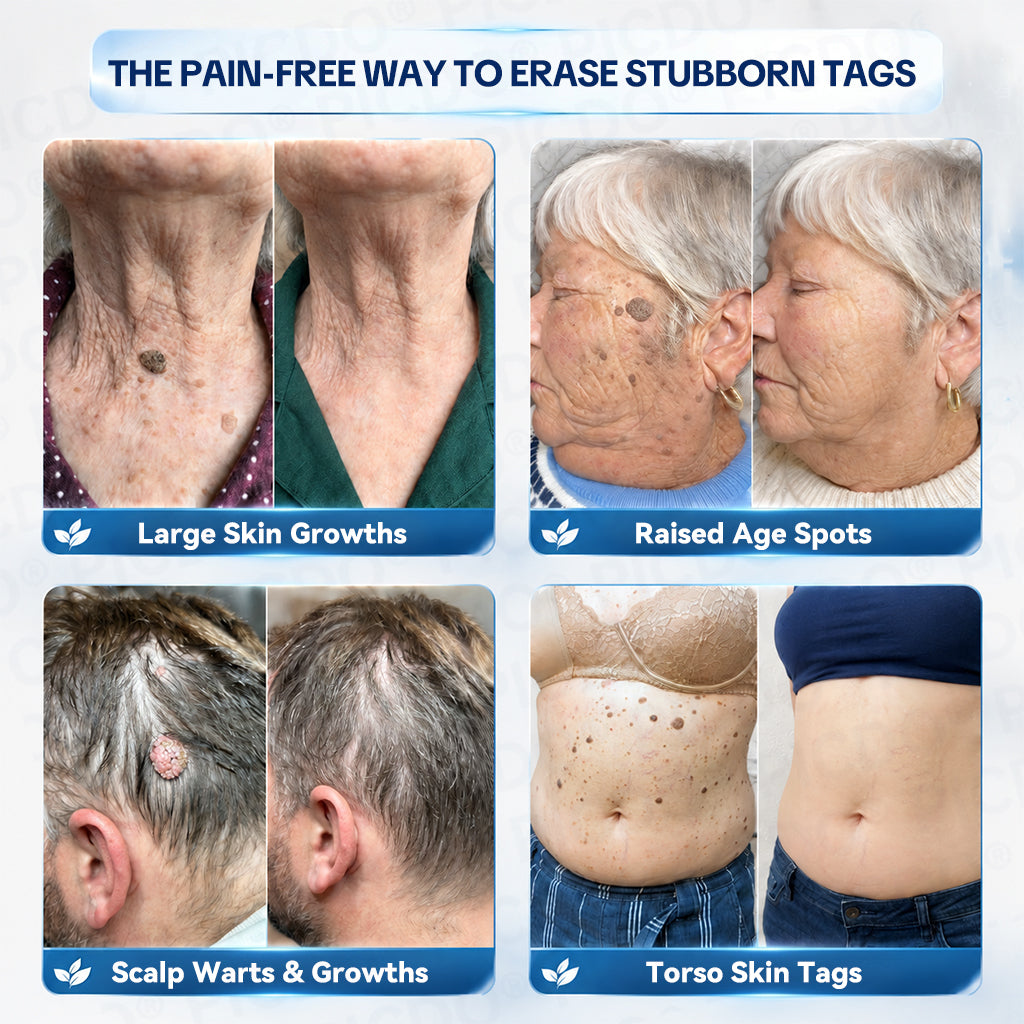TopSpire® 7-𝐃𝐚𝐲 𝐒𝐤𝐢𝐧 𝐓𝐚𝐠 & 𝐒𝐩𝐨𝐭 𝐄𝐫𝐚𝐬𝐞𝐫 𝐂𝐫𝐞𝐚𝐦 (Zero Pain, Zero 𝐒𝐜𝐚𝐫𝐬 Formula)🌱